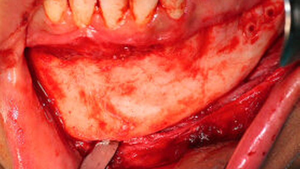 Abbildung 3: Intraoperative Situation im Bereich des Unterkiefers links nach Entfernung des Osteosynthesematerials: Nebenbefundlich zeigte sich kein linker N. mentalis.|