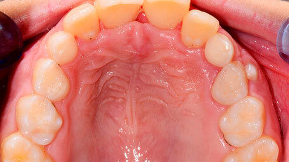3l: Palatinale Ansicht zwei Wochen nach dem Eingriff: Das Diastema centrale hat sich schon beinahe spontan geschlossen. |