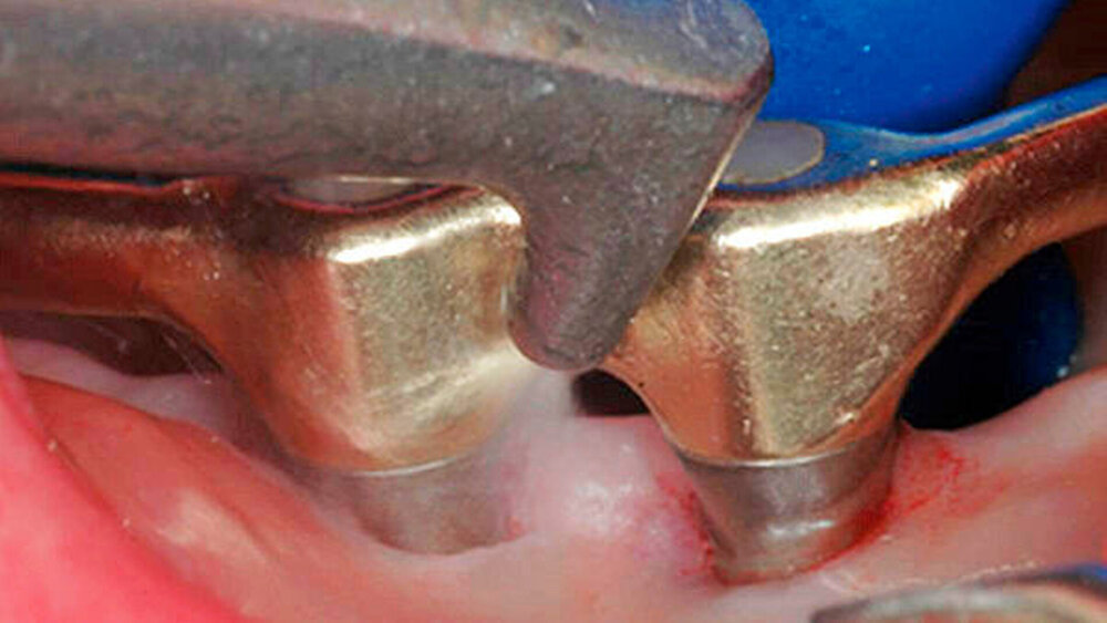 Abbildung 4: Niedrigabrasives Pulverstrahlen ermöglicht eine effiziente Biofilmentfernung auch im periimplantären Gewebe. |
