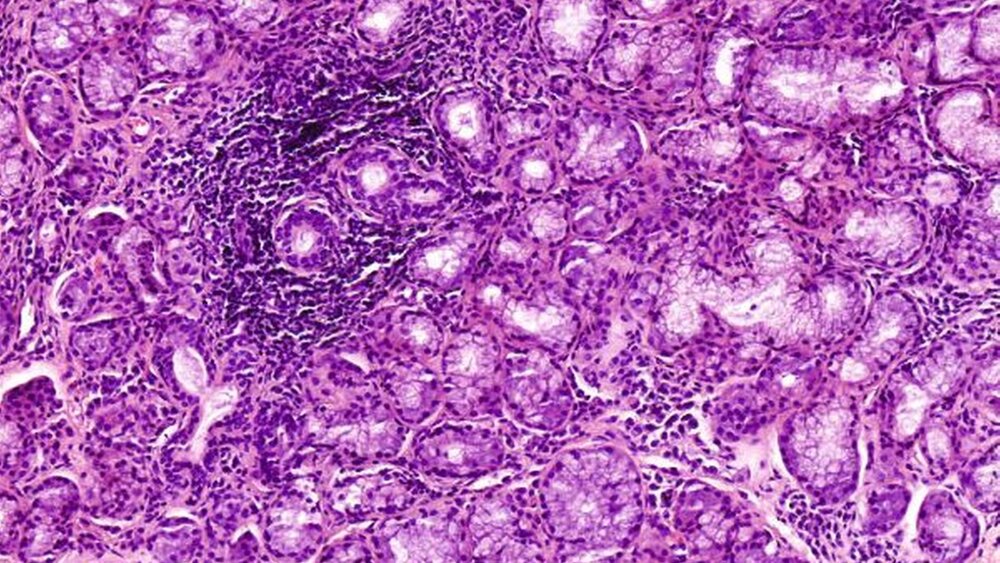 Abbildung 6: Histopathologisches Präparat in HE-Färbung der Gl. labiales mit deutlich erkennbarem fokalem lymphoplasma zellulärem Infiltrat und Anschnitten der Drüsenazini |