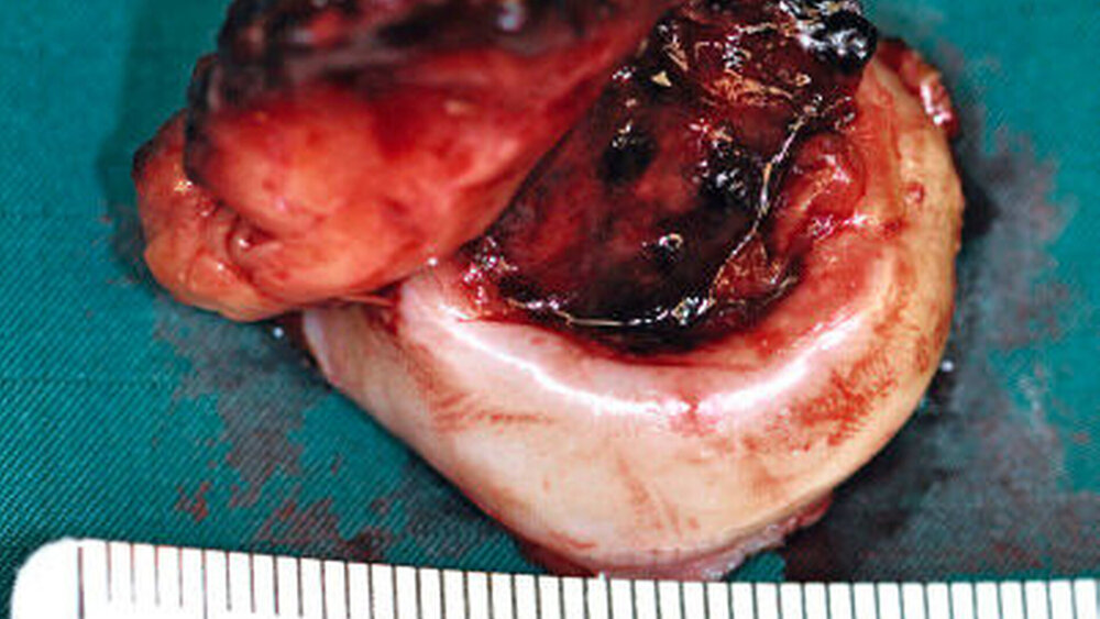 Abbildung 3: Der vom Gaumen exzidierte Tumor |