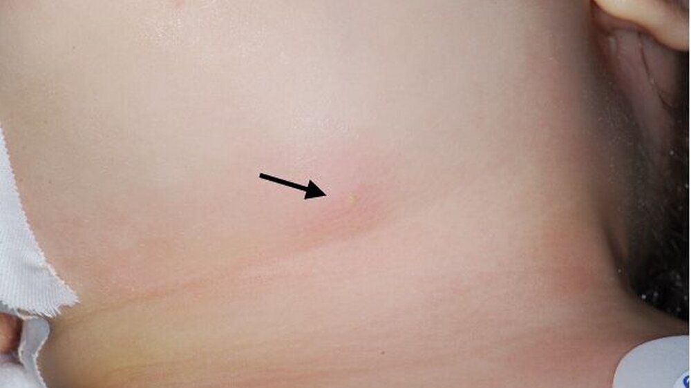 Abbildung 1: Klinischer Aspekt der Raumforderung im Spatium submandibulare links mit einer kleinen fistelmaulartigen Rötung, die sich beim Anspannen der Haut als Einziehung darstellt und damit auf eine Verbindung der Haut mit der Pathologie hindeutet.