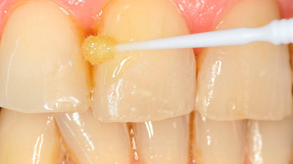 Fluoridlackapplikation bei einem Erwachsenen mit hohem Kariesrisiko\r\n