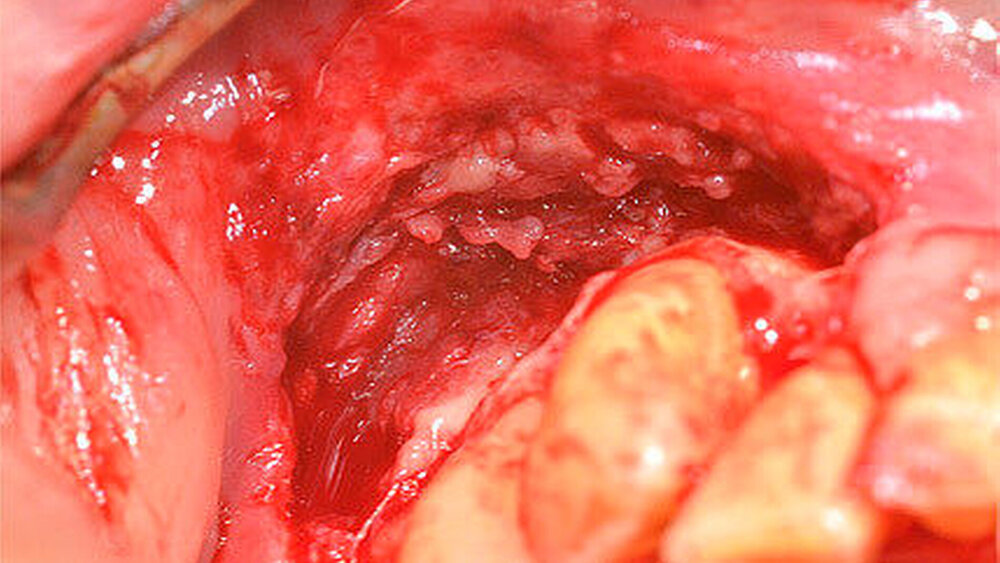 Abbildung 4: Intraoperative Situation nach Abtragung der Nekrose |