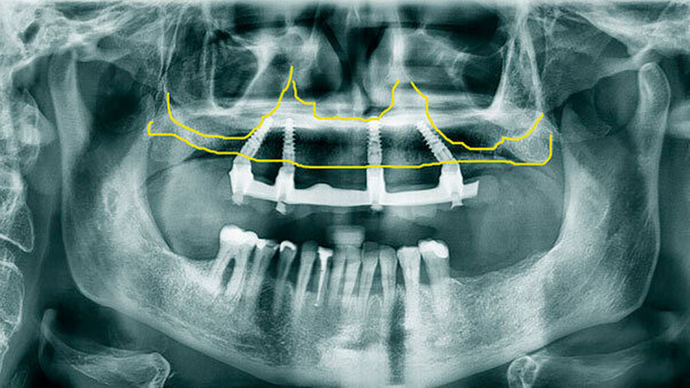 Abbildung 2: Röntgenkontrolle ein Jahr nach Implantation. Die Implantate sind vollständig osseointegriert. |