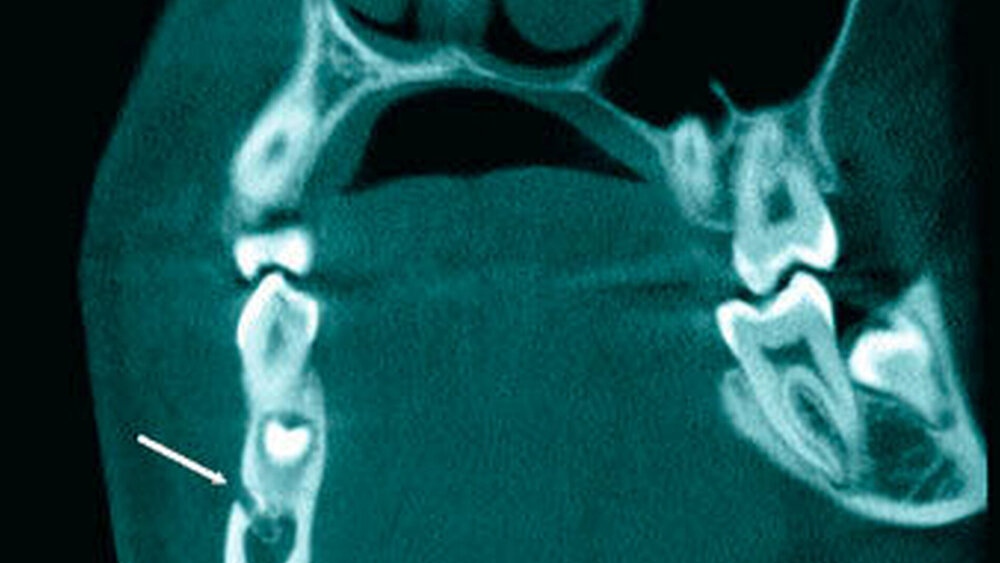 4f: Koronales Schnittbild bei 44+ Darstellung des rechten Foramen mentale (Pfeil). |
