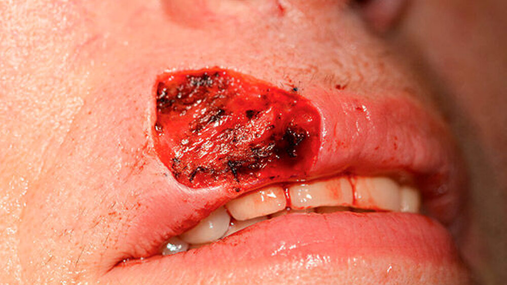 Zum Zeitpunkt der Erstvorstellung der Patientin in der MKG zeigte sich im Bereich der Oberlippe rechts das Lippenweiß, aber auch das Lippenrot betreffend eine etwa 1 cm x 2 cm große Veränderung der Haut.
