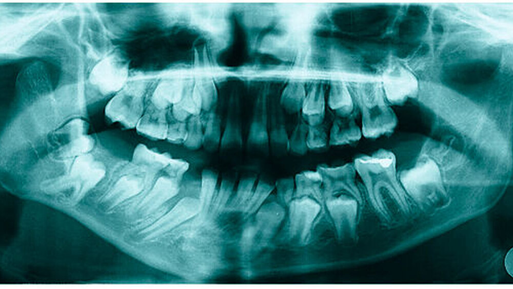 Abbildung 4a: OPG einer 8jährigen Patientin mit hemifazialer Mikrosomie rechts Abbildung |
