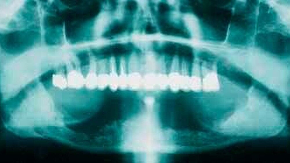 Abbildung 1: Orthopantomogramm (OPG) einer chronischen Osteomyelitis der Mandibula (Zur Verfügung gestellt von Prof. Dr. Dr. Wolff, Bochum)