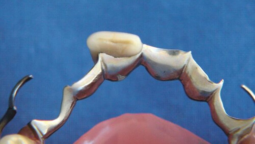 Herausnehmbarer Zahnersatz kann durch einen dentalen Verbinder vorteilhaft erweitert werden, behelfsweise auch unter Einbeziehung der ursprünglichen Zahnkrone. |