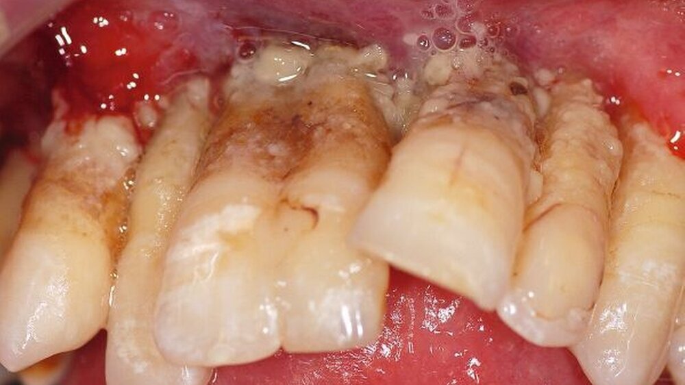 Abbildung 1: Das enorale Bild der Oberkieferfront zum Zeitpunkt der Erstvorstellung mit desolatem Zahn- und Parodontalstatus mit generalisierten harten und weichen Belägen, stark entzündlich veränderter Gingiva mit ausgeprägter Retraktion bis ins unte