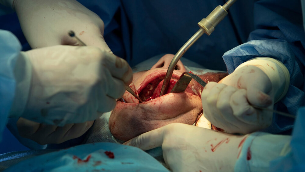 Kieferchirurgische Operation in Großaufnahme mit verschiedenen chirurgischen Instrumenten im Mund des Patienten