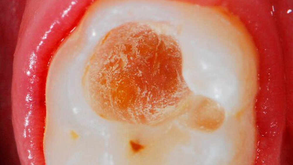 Im Ergebnis der selektiven Exkavation ist deutlich zu erkennen, dass pulpawärts kariöses Dentin belassen wurde, während die Peripherie kariesfrei gestaltet wurde.