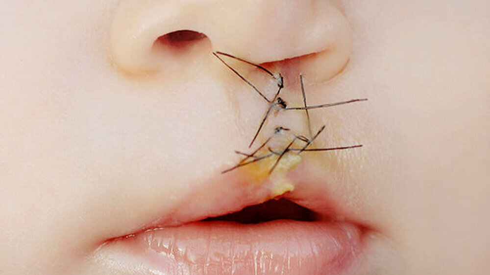 Weltweit kommt eines von 500 Neugeborenen mit einer Lippen-Kiefer-Gaumenspalte zur Welt. Sie ist damit eine der häufigsten angeborenen Fehlbildungen. Die Behandlung ist komplex und langwierig, in der Regel sind mehrere Operationen im Säuglings- und Kind