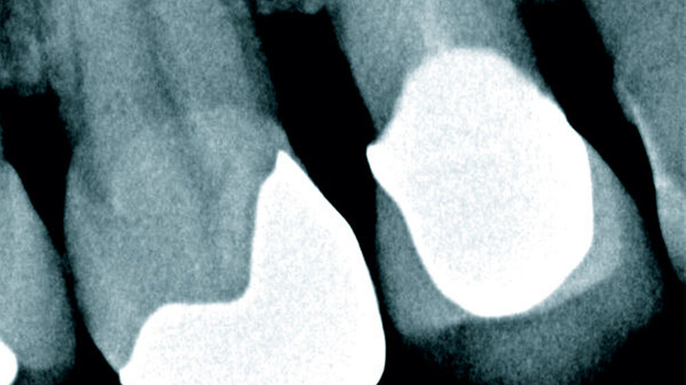 Radiologischer Ausgangsbefund – periapikale Aufhellung regio 14 vereinbar mit einer radikulären Zyste