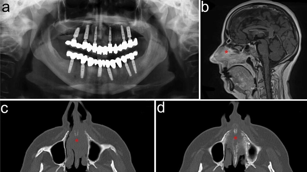 Abbildung 1: Präoperative Befunde: a: Unauffälliges OPT nach implantologischer Versorgung des Oberkiefers; b: MRT mit tumoröser Masse (*) in der Nasenhaupthöhle; c: CT mit Tumor und Knocheninfiltration (*) intranasal, paranasal; d: CT mit Tumor und Kn