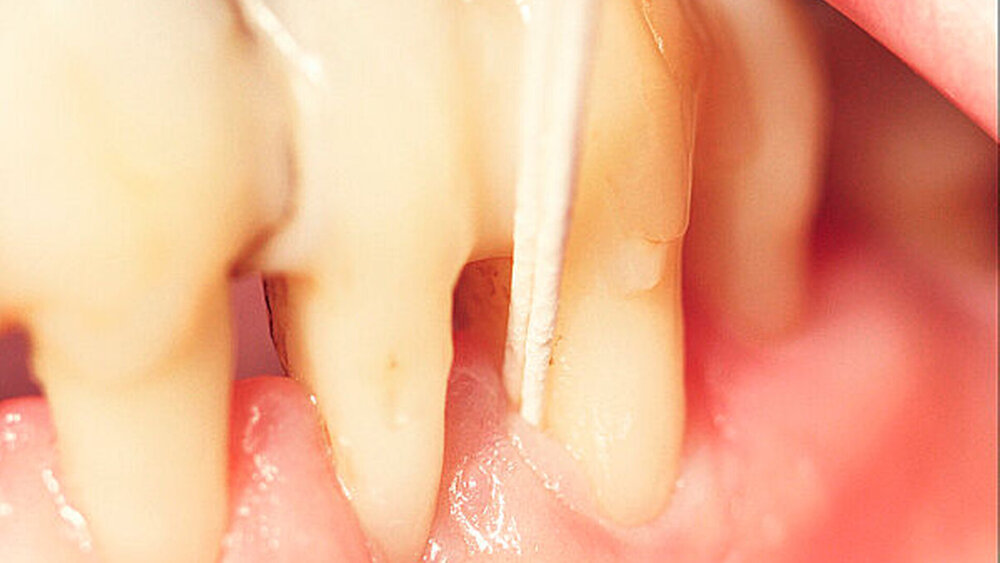 149290-flexible-1900 Abbildung 1: Entnahme der Proben – hier doppelte Entnahme: eine Papierspitze für die Analyse im Labor und eine für die Testung in der Praxis per micro-IDent®direct. |