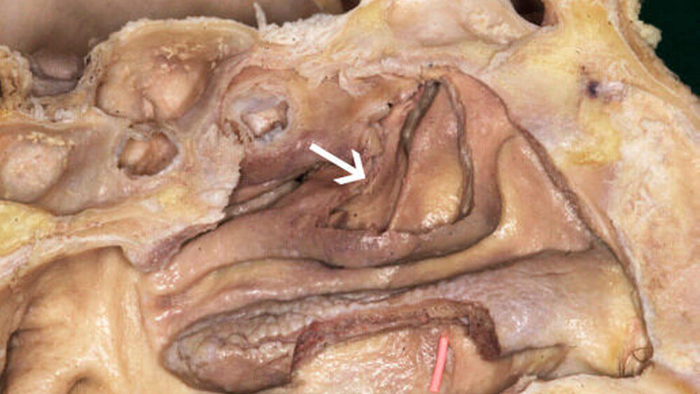 Abbildung 2: Darstellung der lateralen Nasenwand am anatomischen Präparat: Die untere und die mittlere Nasenmuschel sind gefenstert zur Exposition des Tränennasengangs (Guttaperchaspitze) und des Hiatus semilunaris (Pfeil). |