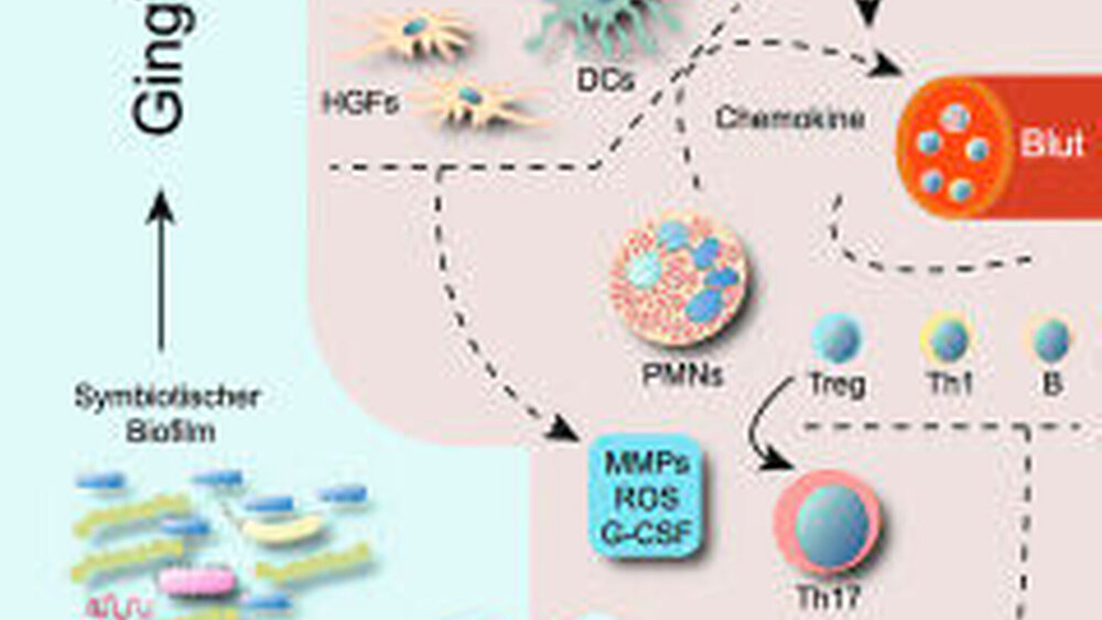 Abbildung 2: Schematische Darstellung der immuno-mikrobiellen Pathogenese der Parodontitis [adaptiert nach Hajishengallis 2014b und Bartold Van Dyke 2013; siehe Text]: Abkürzungen: CCL20 = CC-Chemokinligand 20; DCs = dendritische Zellen; GECs =gingivale Epithelzellen; G-CSF = Granulozytenkolonie-stimulierender Faktor; HGFs = humane gingivale Fibroblasten; IL-8 oder CXCL8 = Interleukin-8; IL-17 = Interleukin 17; MMPs = Matrix-Metalloproteinasen; OCs = Osteoklasten; PMNs = polymorphkernige neutrophile Granulozyten; PPRs = Pattern-Recognition-Receptors; RANKL = Rezeptoraktivator für NFkappaB-Ligand; ROS = reaktive Sauerstoffmoleküle; Th = T-Helferzelle; Treg = regulatorische Helferzelle |