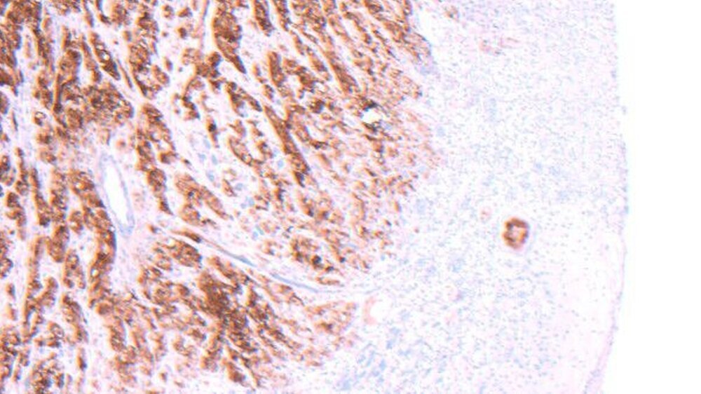 Abbildung 2 b: Immunhistochemische Darstellung der Calretininexpression mit intensiv braun eingefärbten Mesotheliomzellen