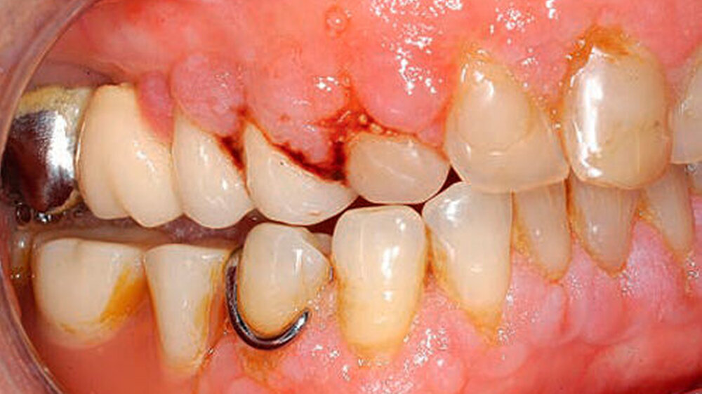 Abbildung 1: Hyperplastische Gingiva mit Blutung