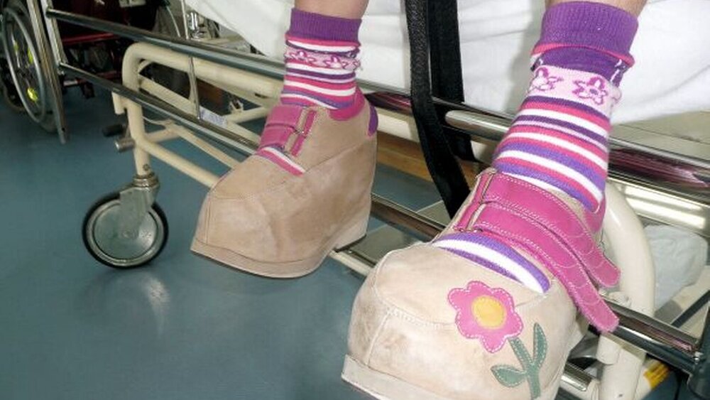 Bei dieser Patientin hatte das Wachstum eines Fußes nicht aufgehört. Es kam zum Riesenfuß, der natürlich besonderes Schuhwerk benötigte. |