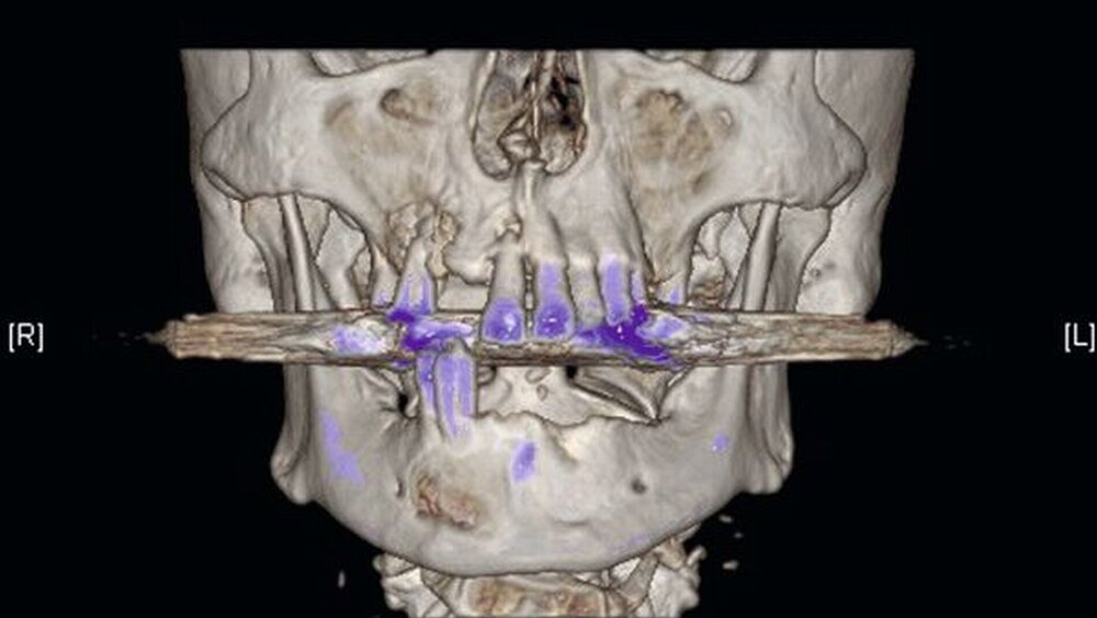 Abbildung 2: In der 3-D-Rekonstruktion des CT-Datensatzes zeigen sich die Destruktion der fazialen Kieferhöhlenwand rechts und die zystische Ausdehnung im UK. |
