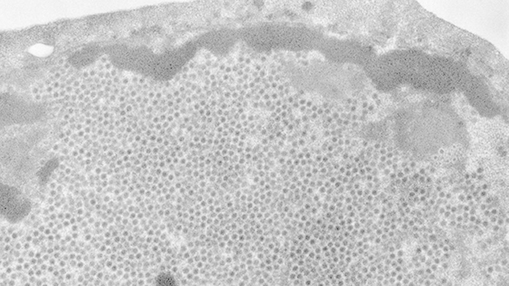 Humaner Papillomvirus (HPV), Biopsie Warze, Transmissions-Elektronenmikroskopie, Ultradünnschnitt. Maßstab = 1µm\r\n