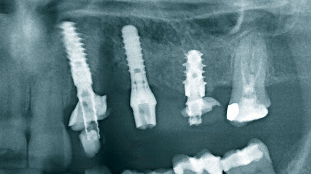 Röntgenkontrolle nach Implantation