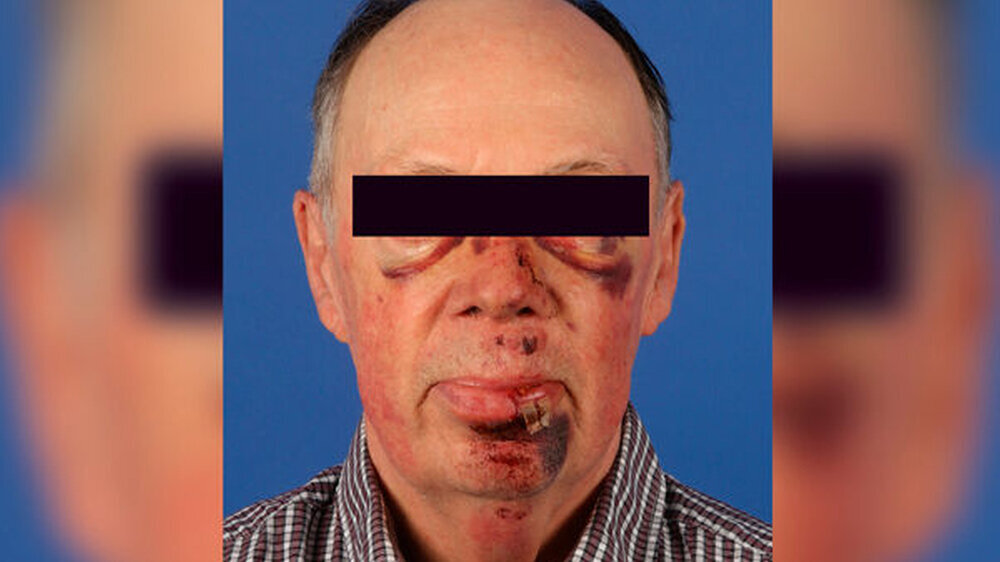 Abb. 1: Klinisches Bild des Patienten direkt nach der notfallmäßigen Wundversorgung\r\n