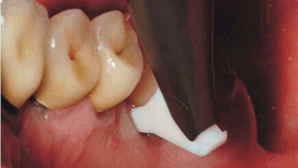 Subgingivales Air-Polishing |