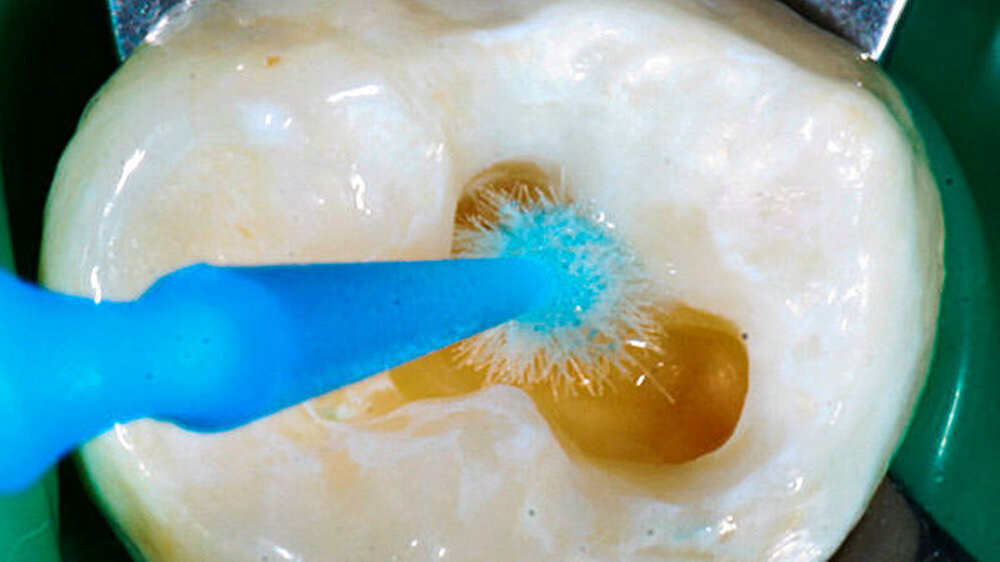 Abbildung 6: Wiederbefeuchten des Dentins (Rewetting) mit 2-prozentiger Chlorhexidinlösung. Durch diesen Arbeitsschritt wird kollabiertes Kollagen wiederaufgerichtet. Zudem deaktiviert das Chlorhexidin körpereigene Enzyme (sog. Matrix-Metallo-Proteinase