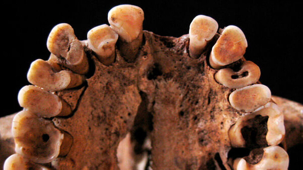 Ein 15.000 Jahre altes Gebiss - und nahezu jeder Zahn ist von Karies zerstört.