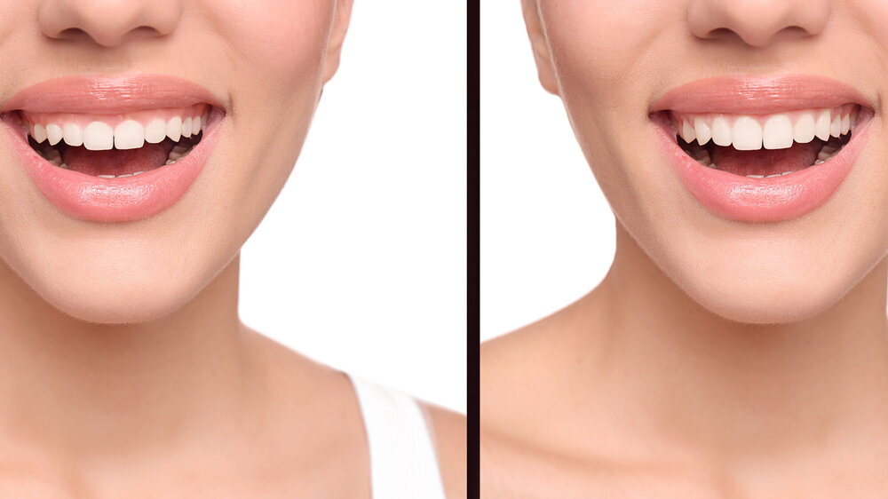 Young woman before and after gingivoplasty procedure on white background, closeup. Banner design Junge Frau vor und nach der Gingivoplastik auf weißem Hintergrund, Nahaufnahme.