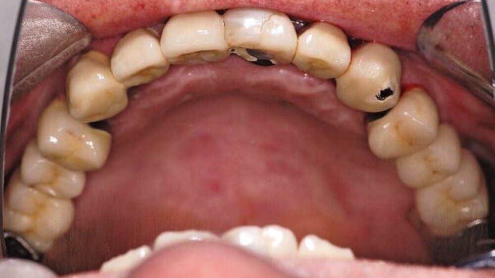 Abbildungen 1a, 1b, 1c: Beim Zubiss zeigt sich die zu geringe vertikale Kieferrelation bedingt durch hochgradig abradierte Zähne (besonders im Unterkiefer). |