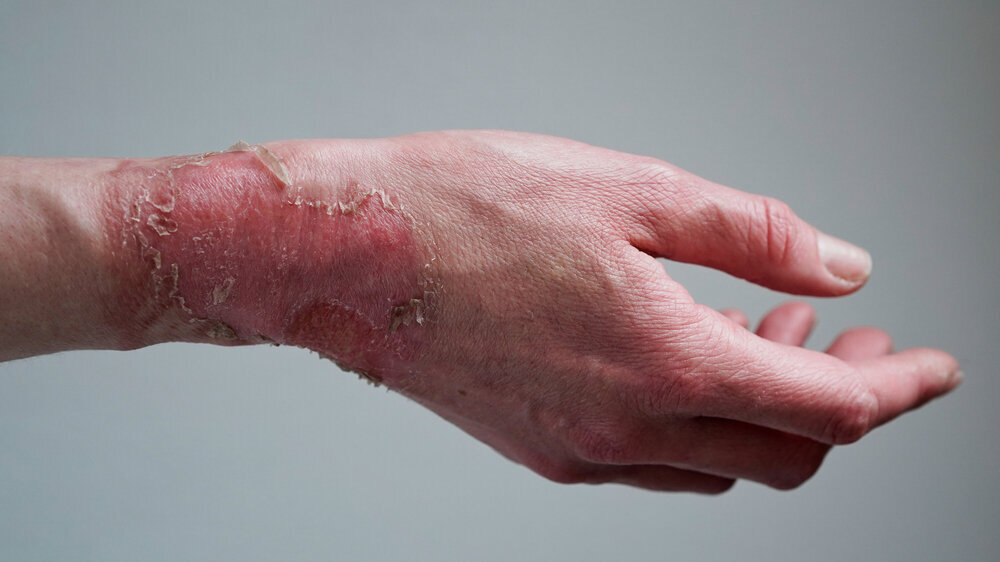 Close-up of a woman's hand with a burst blister from a boiled water burn, broken skin, 1st or 2nd degree burn. Painful wound. Thermal burn. Skin peels off after a burn, wound treatment. macro photo Close-up of a woman's hand with a burst blister from a boiled water burn, broken skin, 1st or 2nd degree burn. Painful wound. Thermal burn. Skin peels off after a burn, wound treatment. macro photo.