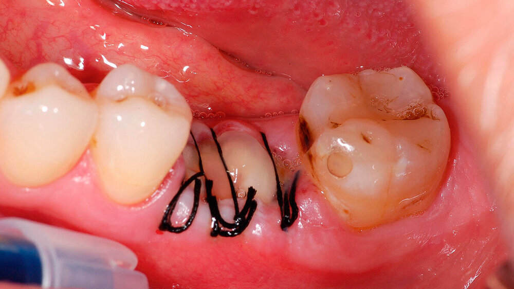 Abb. 1: Alveolar Ridge Preservation nach Extraktion 36 mit zwei in die Alveole eingebrachten und mit Matratzennaht gesicherten autologen PRF-Clot