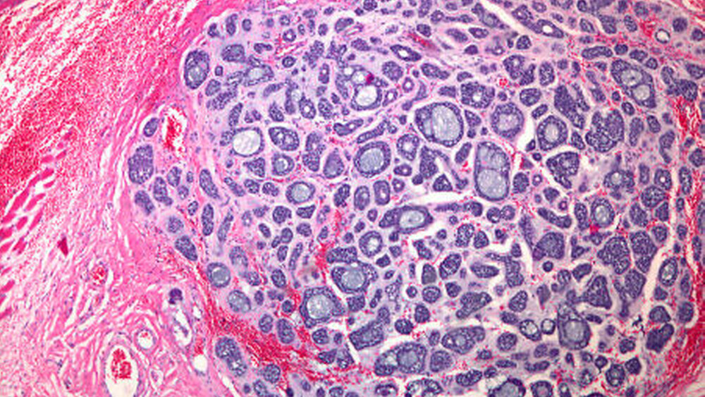 Abbildung 5a: Hämatoxylin-Eosin-Färbung (HE) des adenoidzystischen Karzinoms mit den typischen, überwiegend kribriformen und tubulären Zellformationen: Zwischen den Tumorzellnestern erkennt man lockeres hyalines Stroma. |
