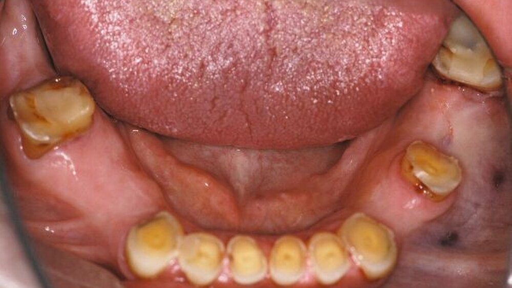 Abbildungen 1a, 1b, 1c: Beim Zubiss zeigt sich die zu geringe vertikale Kieferrelation bedingt durch hochgradig abradierte Zähne (besonders im Unterkiefer). |