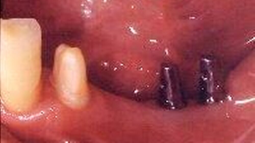 Beispiel für ideale Verhältnisse bei einer Verbundbrücke: zwei Implantate (mit Standarddurchmesser 4 - 5 mm) im Kauzentrum, mit ausreichend langen Prothetikposten.