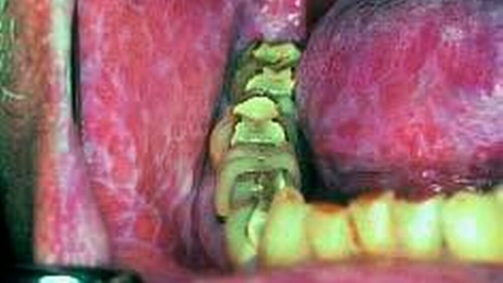 Graft versus host Reaktion nach Immunsuppression und allogener Knochenmarkstransplantation