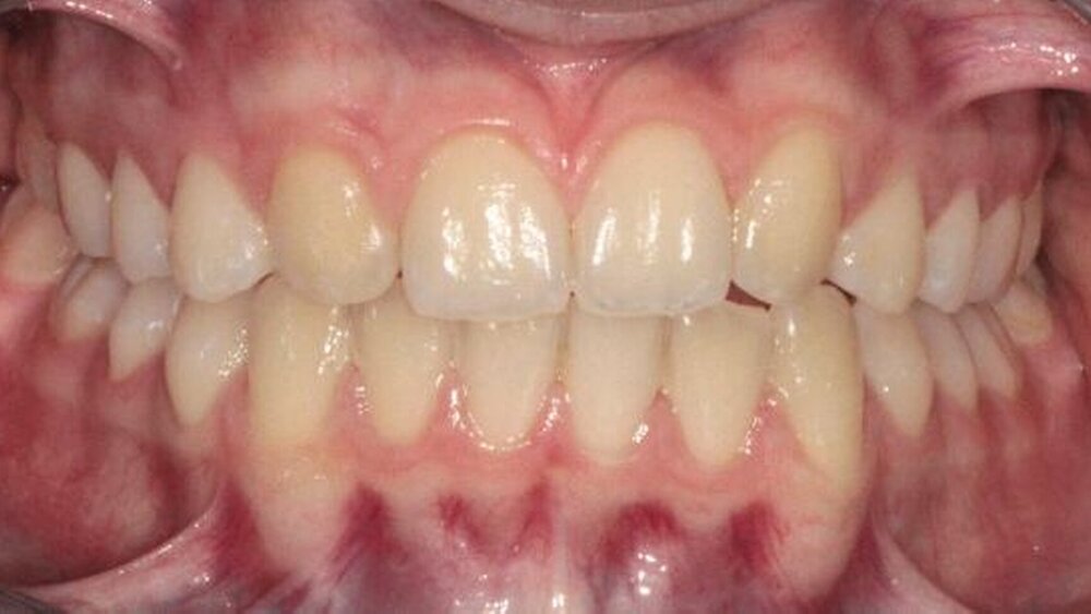 Patientin mit Nichtanlage 12 und 22 nach Behandlung und Lückenschluss durch Einstellung der Canini anstelle der lateralen Inzisivi. |