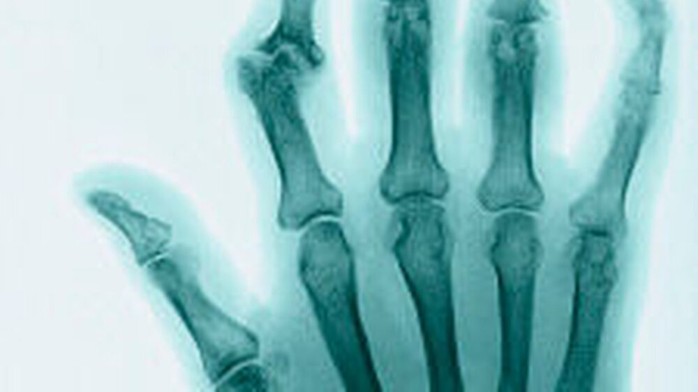 Von der Arthrose sind oft vor allem die Fingergelenke betroffen.