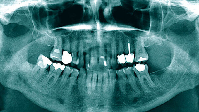 Abb. 1: Die radiologische Ausgangssituation zeigt diffuse, osteolytische Veränderungen des rechten Unterkiefers neben einer ausgeprägten Sklerosierung.