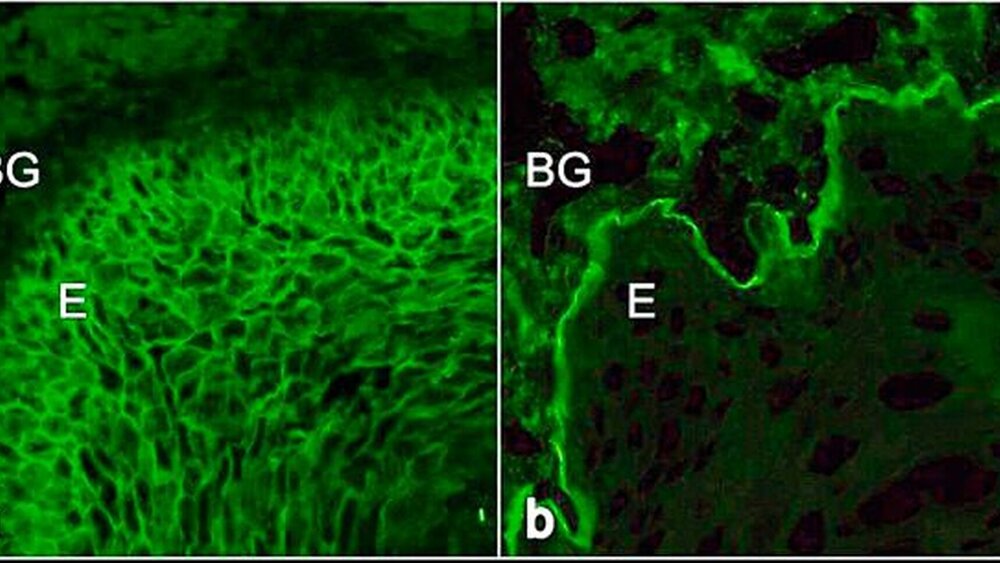 Abbildung 8: In der indirekten Immunfluoreszenz auf Affenösophagus lassen sich Serumautoantikörper bei Pemphigus- und Pemphigoiderkrankungen differenzieren. a: Pemphiguserkrankungen zeigen interzelluläre Ablagerungen von IgG im Epithel des Affenösophagus. b: Pemphigoiderkrankungen weisen lineare Ablagerungen von IgG und/oder IgA und/oder Komplement C3 an der Basalmembran des Affenösophagus auf (Anmerkung: E = Epithel; BG = Bindegewebe). |