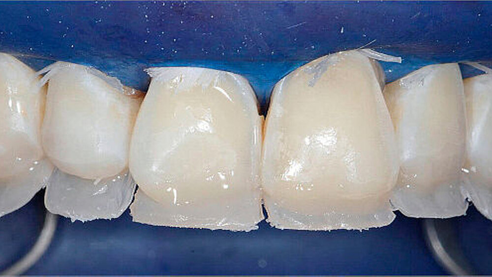 Abbildung 7: Palatinale Rückwände aus Schmelzmasse |