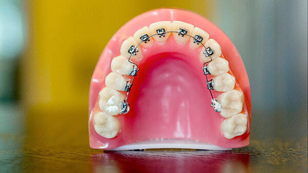 Große Vielfalt an Apparaturen: Die moderne Kieferorthopädie bedient heute alle Altersklassen. |