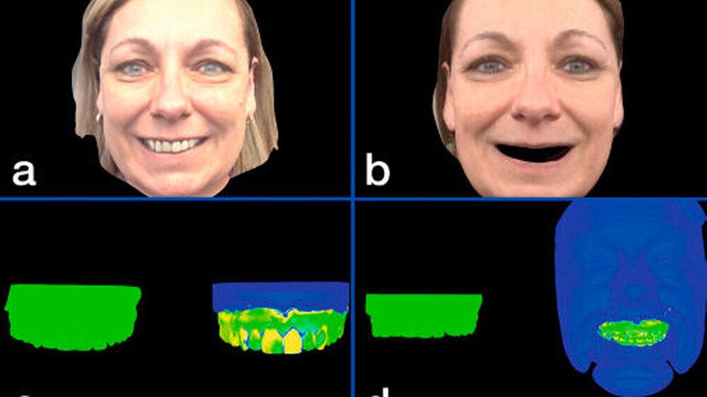 Abbildung 1: Maßstabgetreue, natürliche Darstellung (3-D-Gesichts-Scanner, priti-mirror) des Patientenkopfes, der am Bildschirm dreidimensional betrachtet werden kann: Situationsdarstellung (Ausgangssituation) Frontansicht mit lächelnden Lippen: (a) insuffiziente Frontzahnrestaurationen (b) ausgeschnittene Frontzähne zur Darstellung der virtuell geplanten Zahnposition (c) Modell-Scan der Ausgangssituation (links) und Überlagerung des Datensatzes der Ausgangssituation und des virtuellen Wax-ups (rechts) (d) Übertragung der Wax-up-Konstruktion auf den Gesichts-Scan |