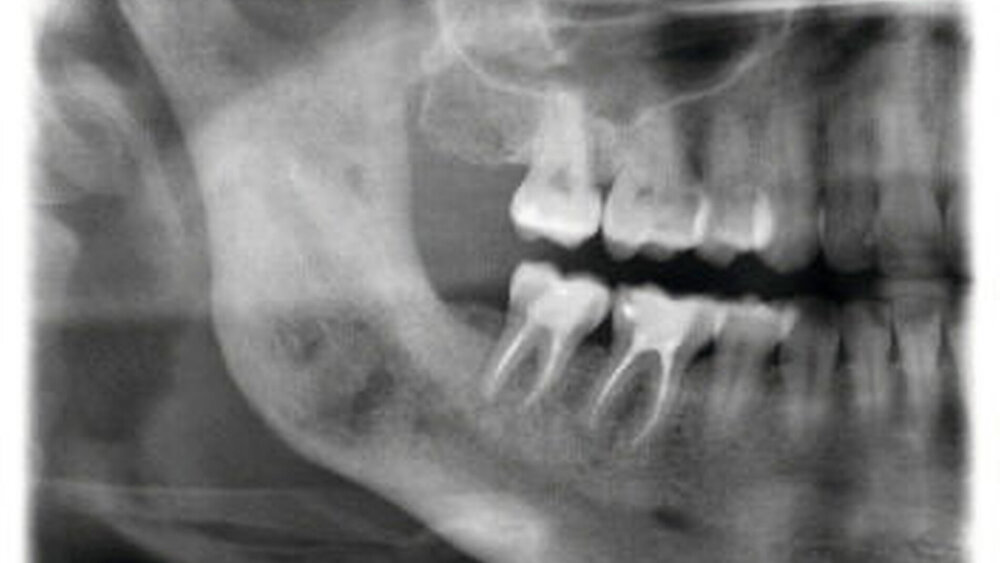 Halbseiten-OPG rechtsseitig mit Darstellung der suffizienten Wurzelkanalfüllungen der Zähne 46 und 47 ohne eine apikale Osteolyse. Im Bereich des Kieferwinkels zeigt sich eine runde, unruhige Osteolyse als Verdacht auf eine Osteomyelitis des Unterkiefers. |