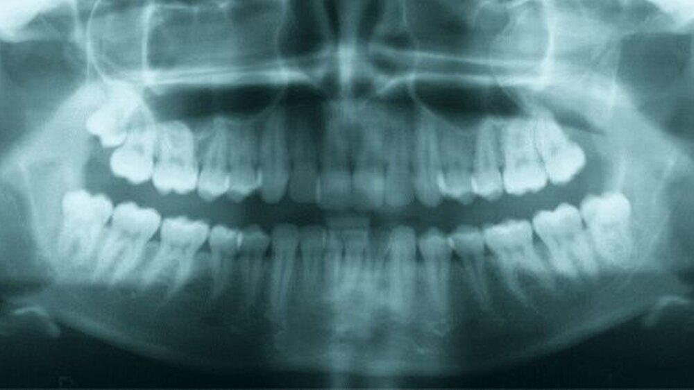 Abbildung 1: Im Orthopantomogramm zeigt sich eine Verschattung der dorsalen Kieferhöhle links, wobei nach anterior eine scharfe Begrenzung erkennbar wird.